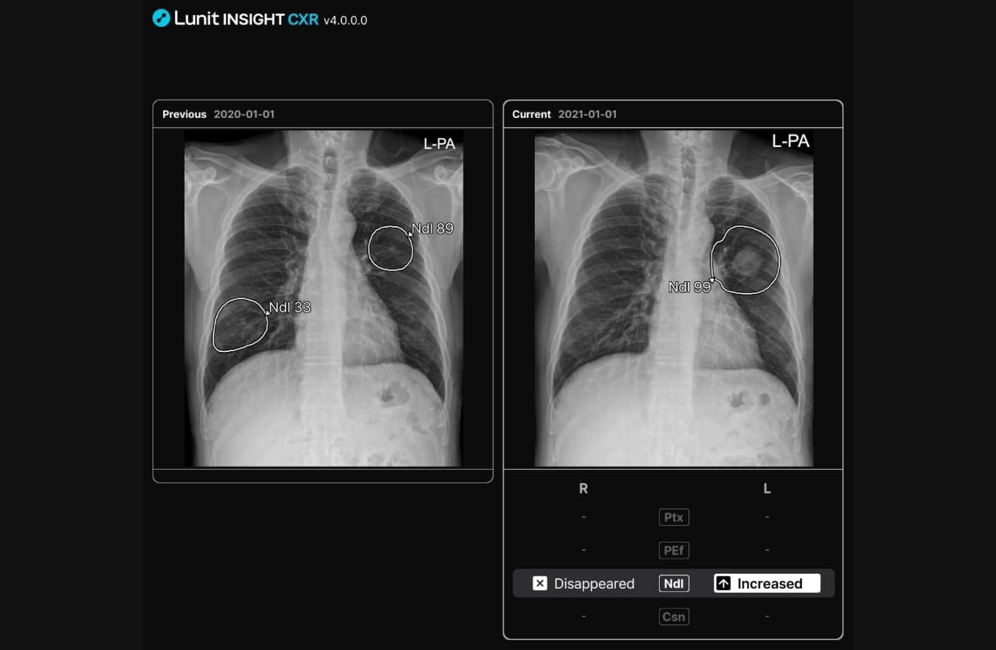 Lunit INSIGHT CXR 서비스 소개 이미지